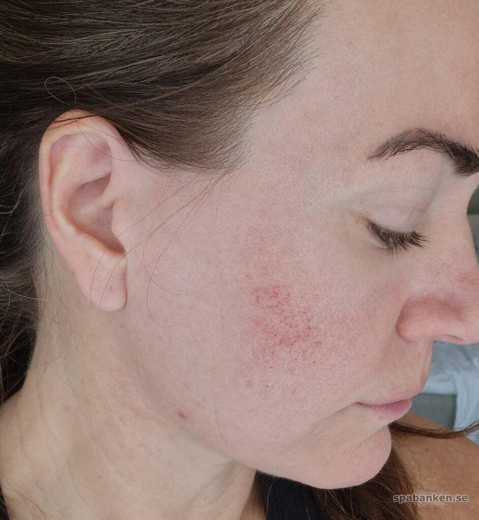 Jag fick märken efter organic botox.